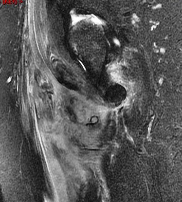 Figure 2 for case Psoas avulsion